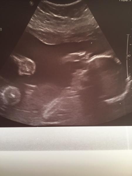 Bild zu Feindiagnostik hinter uns :) - Forum für Oktober - Mamis