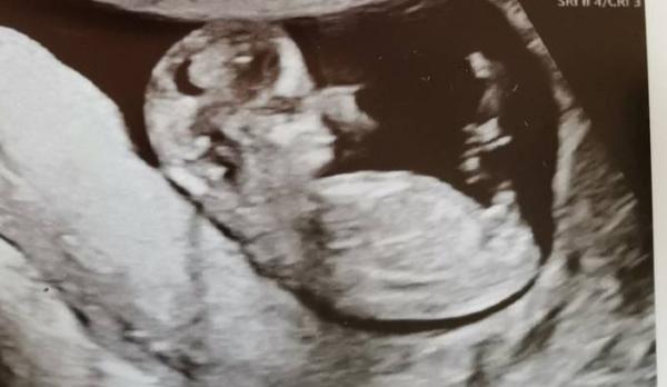 Bild zu Ultraschall 12+1 Mädchen oder Junge? - Forum für Oktober - Mamis