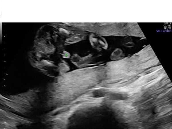 Bild zu 20.SSW: Eindeutig Junge? Oder Nabelschnur? - Forum für Oktober - Mamis