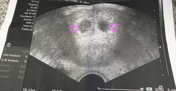 Bild zu Erster Ultraschall đ„° - Forum fĂŒr Oktober - Mamis