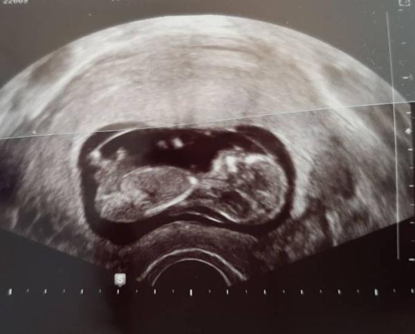 Bild zu Auch erster großer Schall vorbei - Forum für Oktober - Mamis