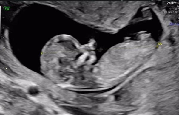 Bild zu First Trimester Screening... - Forum für Oktober - Mamis