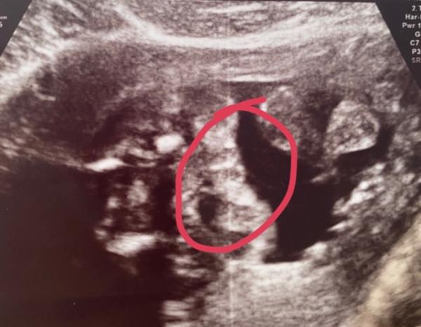 Bild zu SSW 22 erst Junge dann doch Mädchen - Forum für Oktober - Mamis