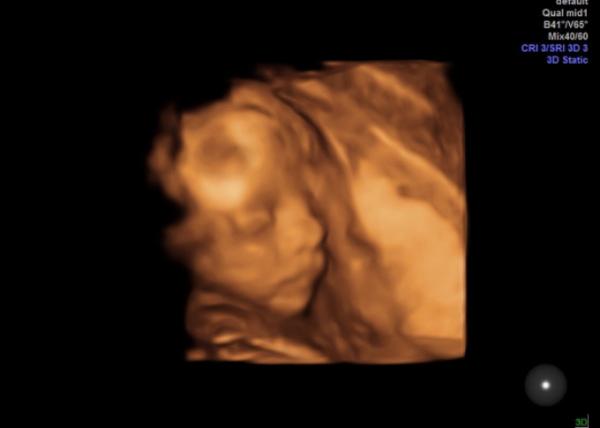 Bild zu 3D Ultraschall - Forum für Oktober - Mamis