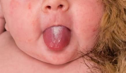 Bild zu Ist das Mundsoor? - Forum für Oktober - Mamis