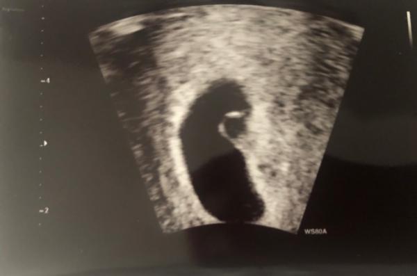 Bild zu 1. Ultraschallbild - Forum für Oktober - Mamis
