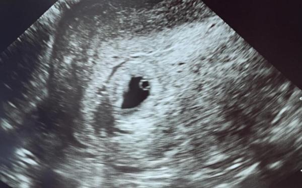 Bild zu Erster Ultraschall - Forum für Oktober - Mamis