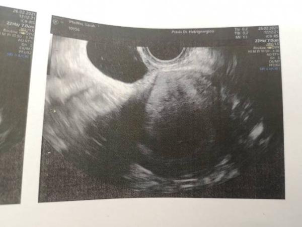 Bild zu Leere Fruchthöhle 6 +1 - Forum für Oktober - Mamis