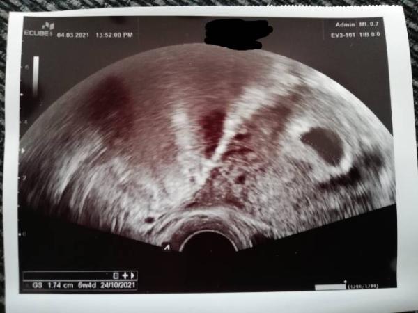 Bild zu Leere Fruchthöhle in 6+2? - Forum für Oktober - Mamis