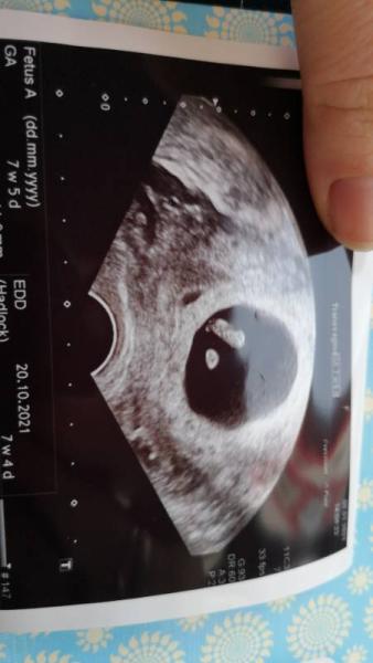 Bild zu Alles ist gut - 3. Ultraschall - Forum für Oktober - Mamis