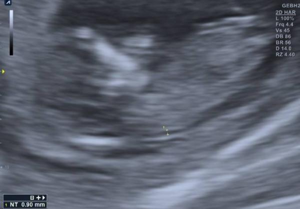 Bild zu Enttäuscht vom Ultraschall - Forum für Oktober - Mamis