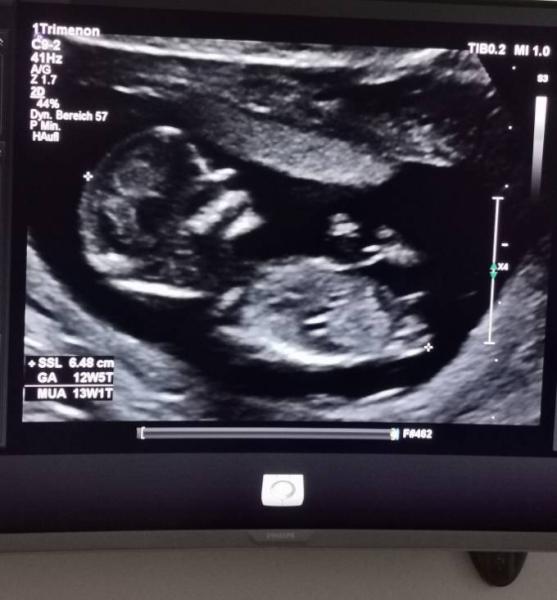Bild zu NUB theorie Ultraschallbild - Forum für Oktober - Mamis