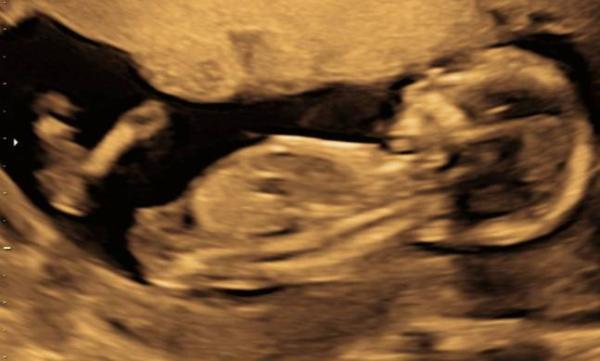 Bild zu Nub - was denkt ihr? - Forum für Oktober - Mamis