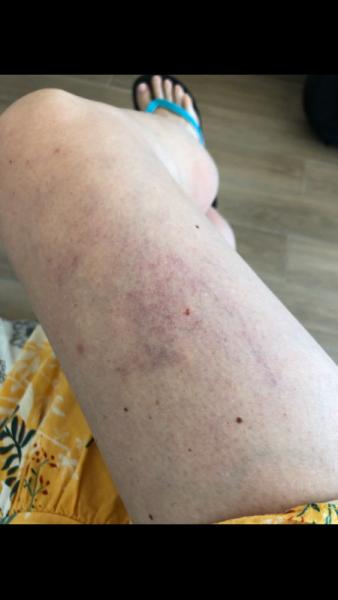 Bild zu Besenreißer - schwangerschaftsstreifen - krampfadern - Forum für Oktober - Mamis