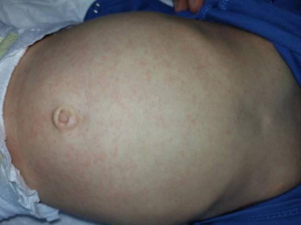 Bild zu Röteln? - Forum für Oktober - Mamis