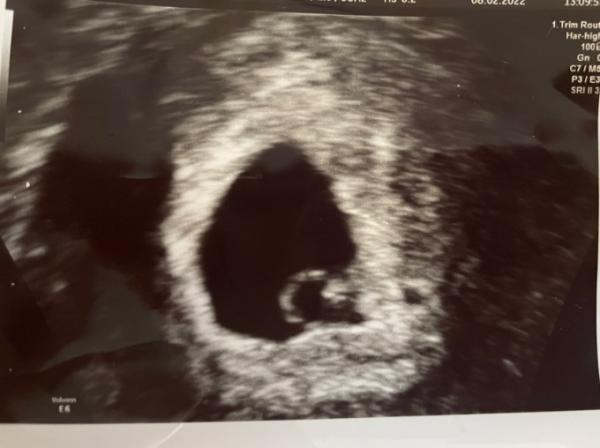 Bild zu Mein Baby ET 05.10 SSW 5+6 - Forum für Oktober - Mamis