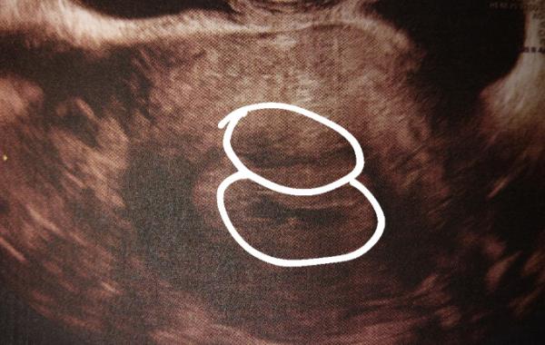 Bild zu 2 Fruchthöhlen - Forum für Oktober - Mamis