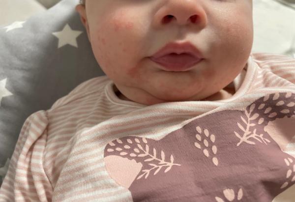 Bild zu Ausschlag im Gesicht? Oder was anderes - Forum für Oktober - Mamis