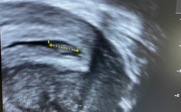 Bild zu Flache Fruchthöhle - Forum für Oktober - Mamis