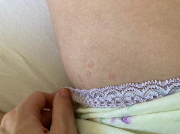 Bild zu Rote Punkte Intimbereich - Forum für Oktober - Mamis