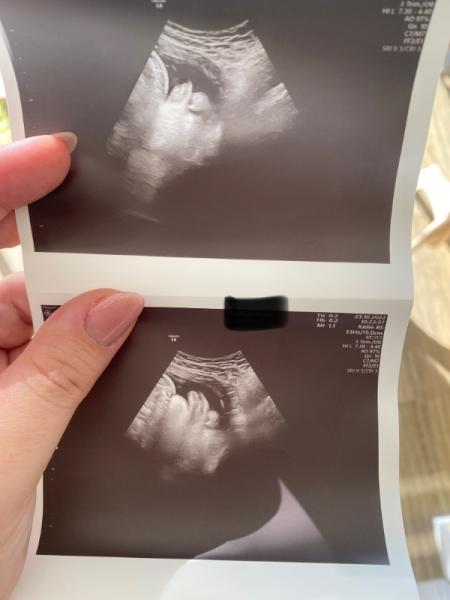Bild zu Hilfe - erschreckendes Ultraschallfoto - Forum für Oktober - Mamis