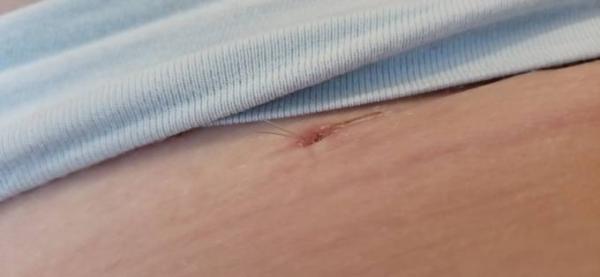 Bild zu Kaiserschnitt selbst auflösende fäden - Forum für Oktober - Mamis
