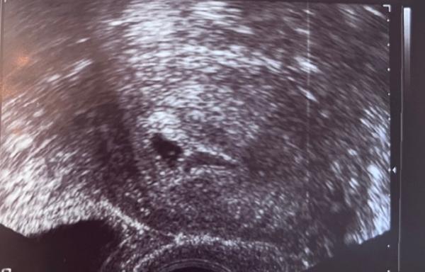 Bild zu Fruchthöhle und Dottersack sind zu sehen ❤️ - Forum für Oktober - Mamis