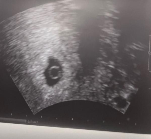 Bild zu Entlassung aus der KIWU Klinik und neues Bild - Forum für Oktober - Mamis