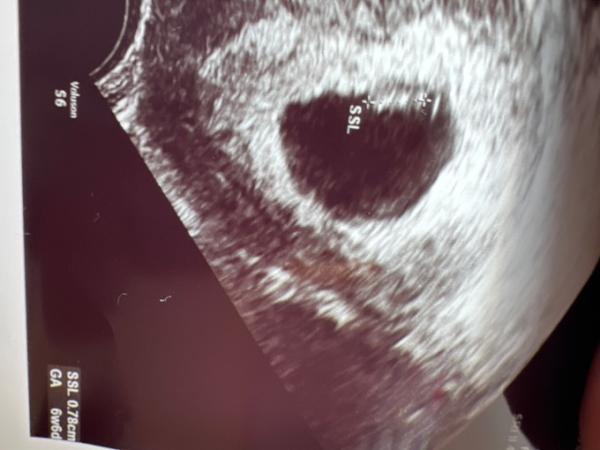 Bild zu Update 2. FA Termin - Forum für Oktober - Mamis
