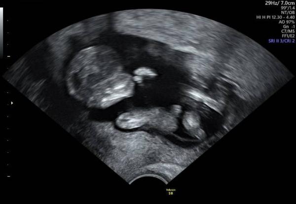 Bild zu NIPT+ Ultraschall - Forum für Oktober - Mamis
