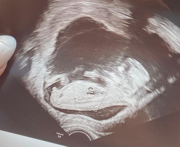 Bild zu Erfahrungen erbeten! 14ssw - Forum für Oktober - Mamis