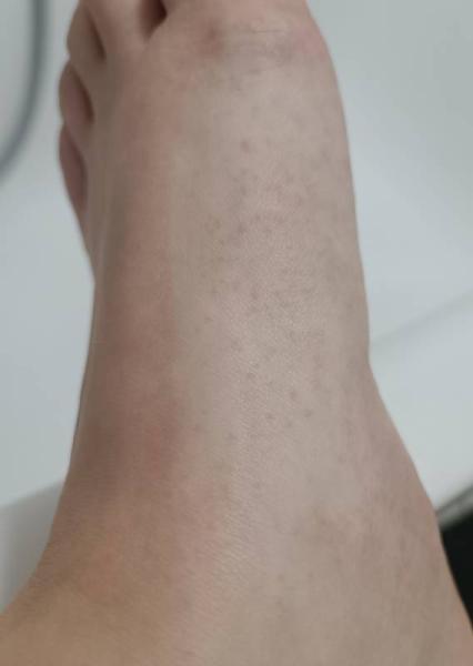 Bild zu Kleine rote Pünktchen am Fuß - Forum für Oktober - Mamis