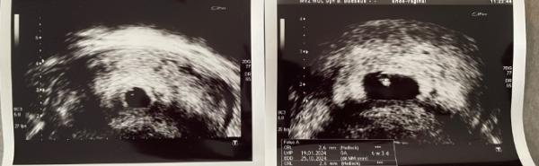 Bild zu US die Zweite! 6ssw+3T… - Forum für Oktober - Mamis
