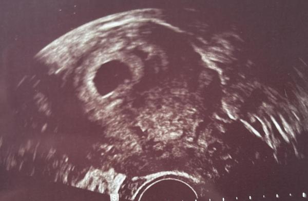 Bild zu Ultraschall 6+1 - Zwillinge - Forum für Oktober - Mamis