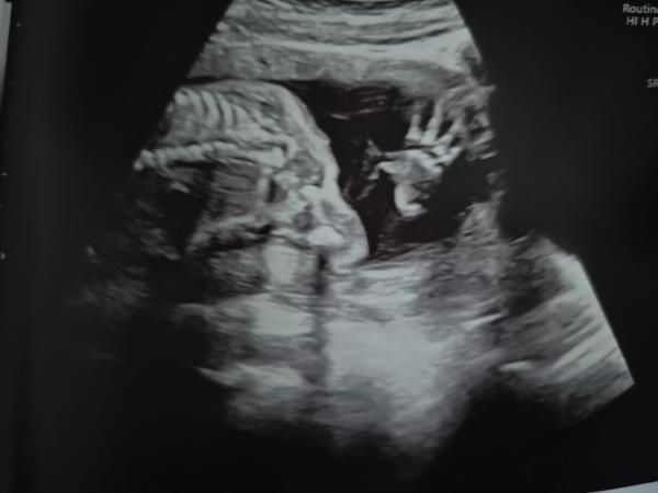Bild zu 2. Screening und Verbrennungsklinik - Forum für Oktober - Mamis