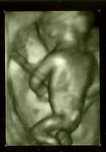 Bild zu Vorzeitige VU mit 3D-Bild - Forum für November - Mamis