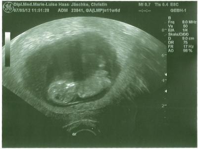 Bild zu Hatte gestern Ultraschall:) - Forum für November - Mamis