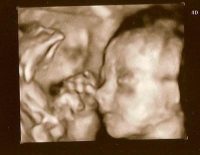Bild zu 3D Ultraschall - Forum für November - Mamis