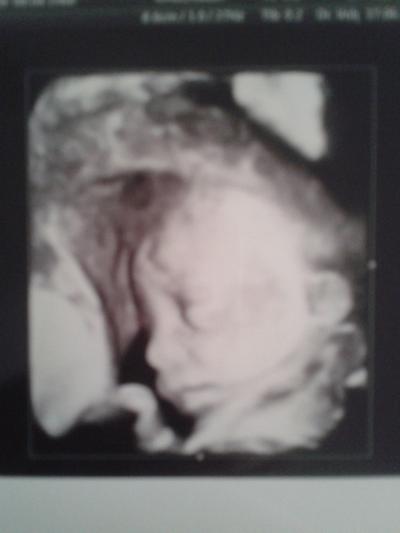 Bild zu feindiagnostik :-) - Forum für November - Mamis