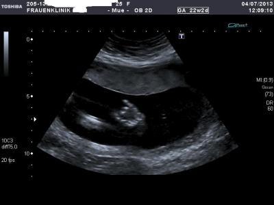 Bild zu Zurück von Feindiagnostik - Forum für November - Mamis