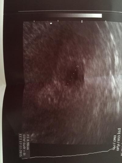 Bild zu Wie groß war eure Fruchthöhle in der 6. SSW ? - Forum für November - Mamis