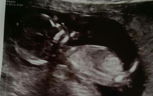 Bild zu Nackentransparenzmessung und Outig - Forum für November - Mamis