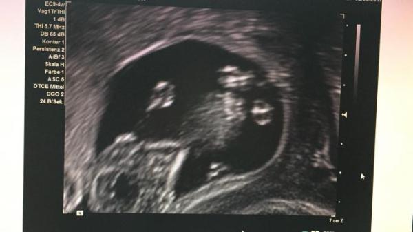 Bild zu Heute 1. Trimester screening - Forum für November - Mamis