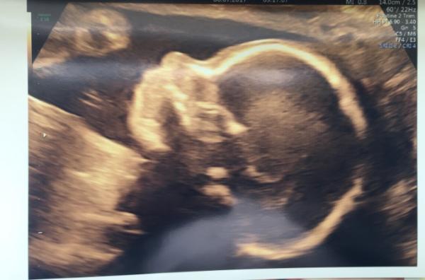 Bild zu Heute Feinultraschall - Forum für November - Mamis