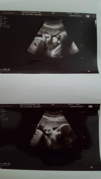 Bild zu Gestern 3. Großen Ultraschall. Baby zu groß und ss Diabetes  - Forum für November - Mamis