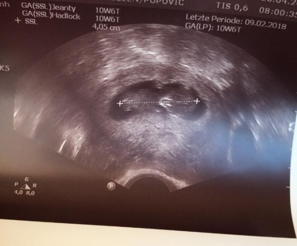 Bild zu 1.trimesterscreening, Harmony , großer Zuckertest - Forum für November - Mamis