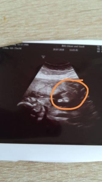 Bild zu Ultraschallbild - Forum für November - Mamis