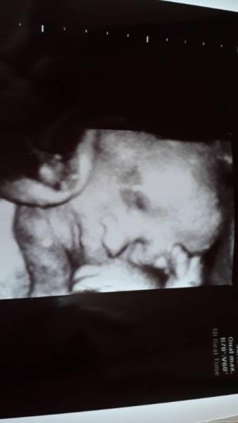 Bild zu Nabelschnur um den Hals - Forum für November - Mamis