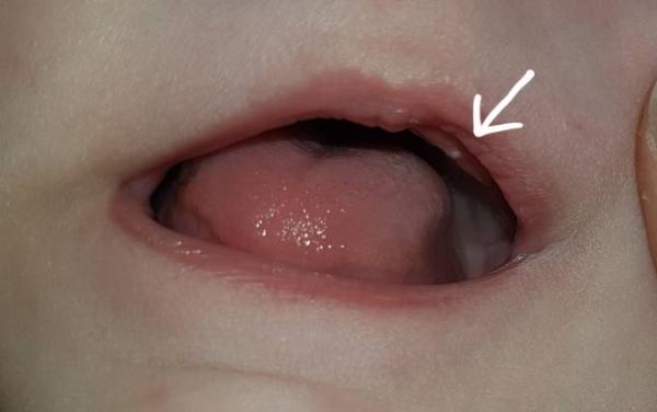 Bild zu Das erste Zähnchen? - Forum für November - Mamis