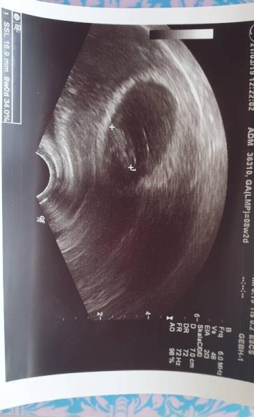 Bild zu Nochmal Ultraschall heute - Forum für November - Mamis